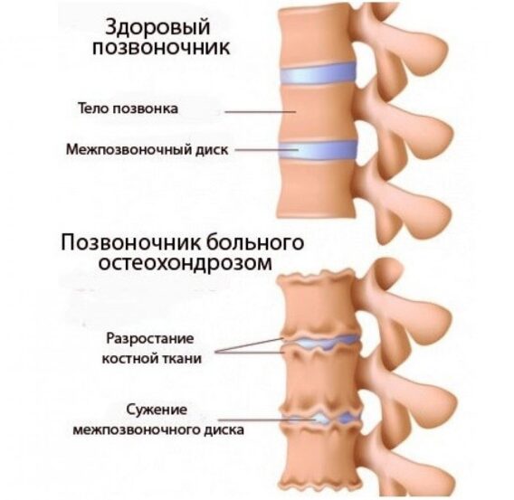 Лечение остеохондроза в Николаеве - фото 2