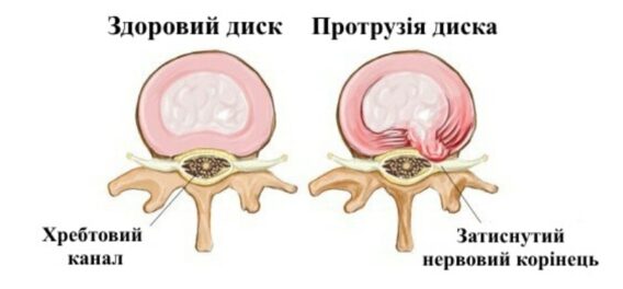 Лечение протрузии в Николаеве - фото 2