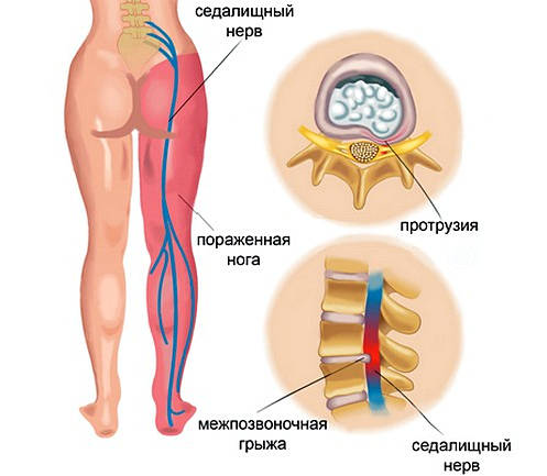 Лечение ишиаса в Николаеве - фото 2