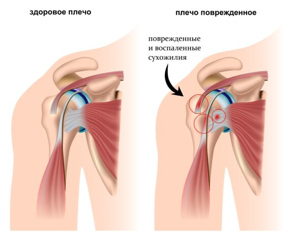 Боль в плече лечение в Николаеве - фото 2