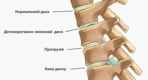 Біль у попереку лікування в Миколаєві - фото 2