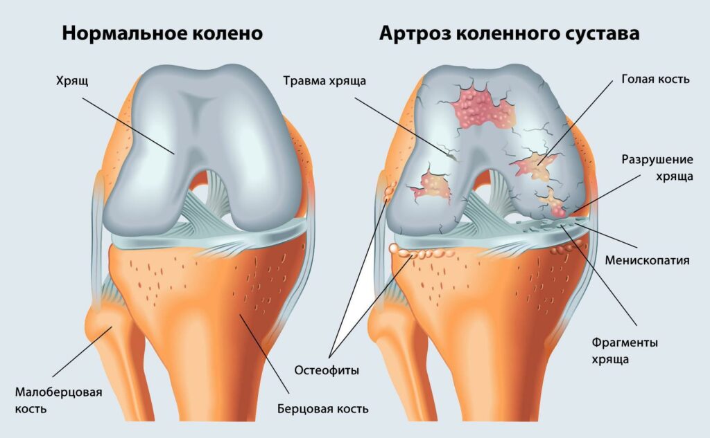 Як лікувати артроз: перевірені методи та корисні поради