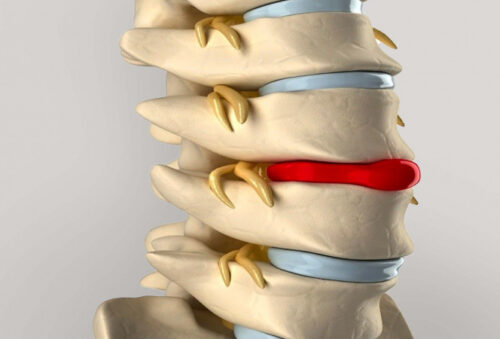 Унікальна методика SanoSpine в лікуванні міжхребцевих гриж
