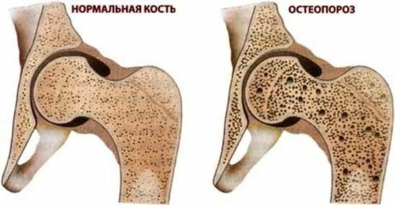 Лечение остеопороза позвоночника в Николаеве