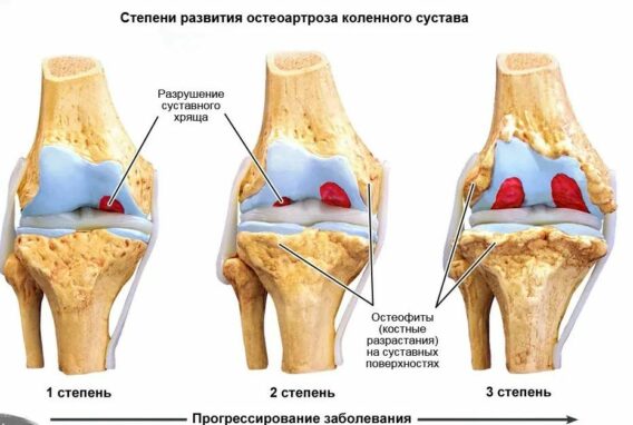 Лікування остеопорозу в онкохворих в Миколаєві - фото 2