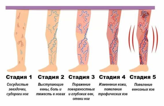 Лікування тромбозу глибоких вен в Миколаєві - фото 2