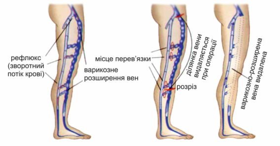 Лікування варикозу в Миколаєві - фото 2