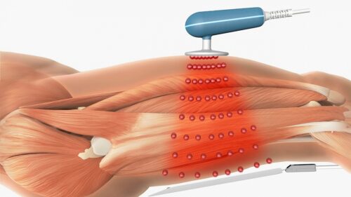 Що таке текар-терапія і кому вона справді допомагає