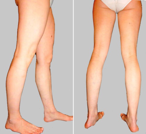 Чи впливає варикоз на ефект нейрореабілітації?