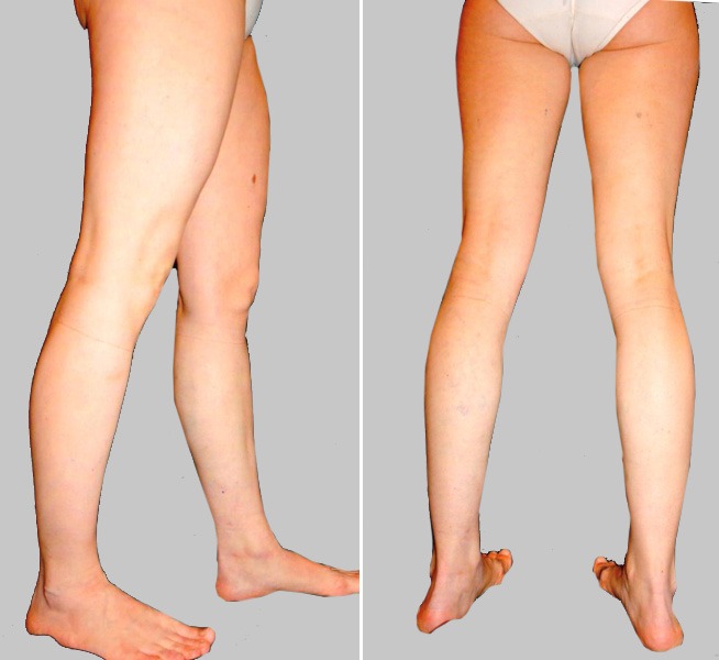 Чи впливає варикоз на ефект нейрореабілітації?