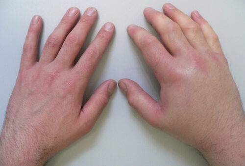 Як не допустити лімфостаз після операції