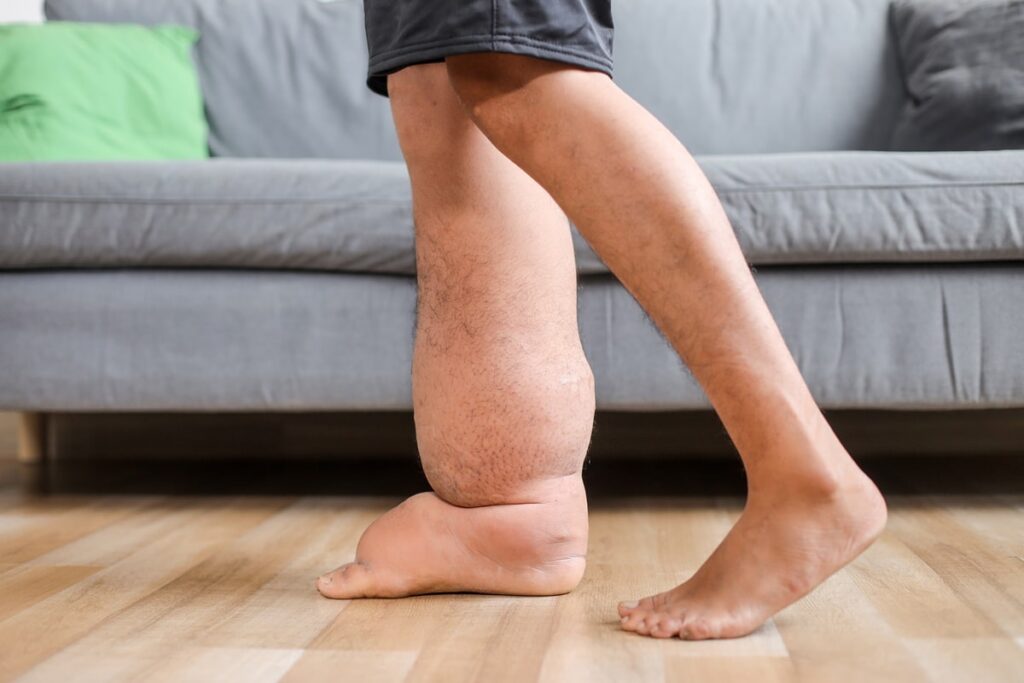 Що таке лімфостаз і чому виникають хронічні набряки?