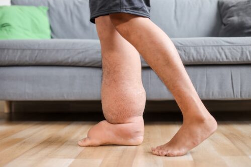 Що таке лімфостаз і чому виникають хронічні набряки?