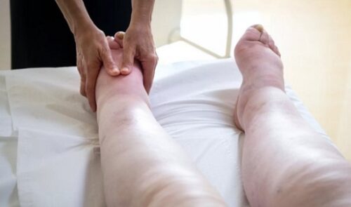 Коли лімфодренажний масаж при лімфостазі корисний, а коли — шкідливий?