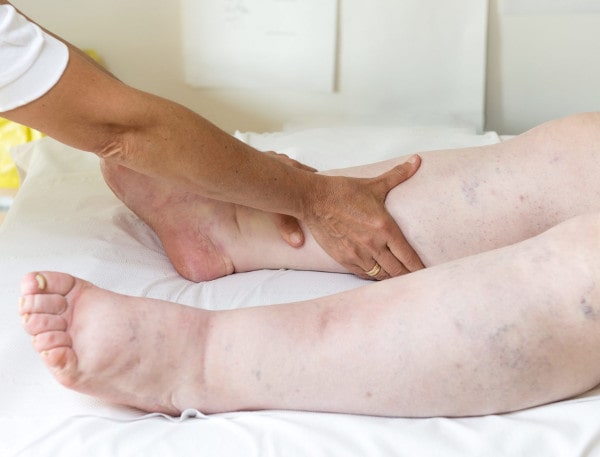 Лімфостаз нижніх кінцівок: які симптоми варто не ігнорувати?