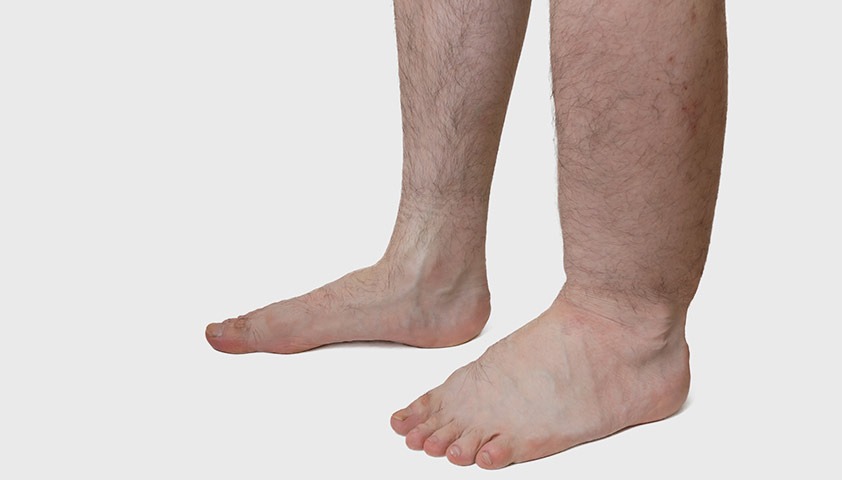 Чи можна обійтись без компресії при лімфостазі?