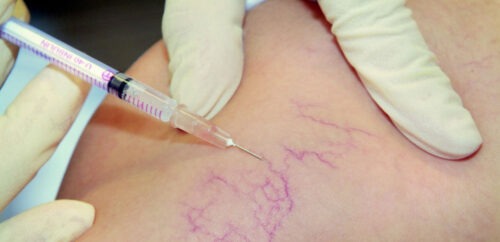 Безпечна склеротерапія для судинних зірочок — на що чекати