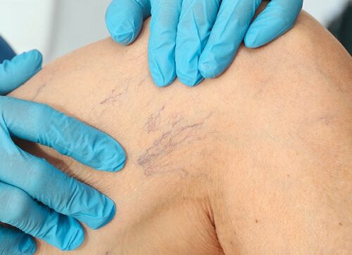 Лікування спастики і варикозу: що можна поєднувати безпечно