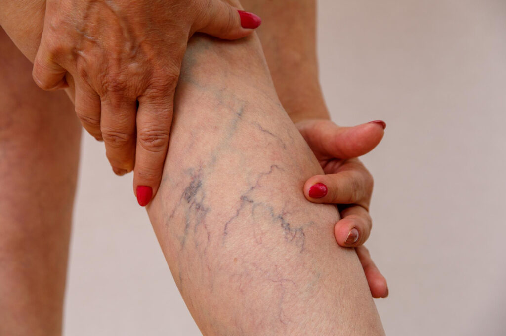 Як полегшити біль в ногах після тромбозу — масаж, ботокс чи ліки?