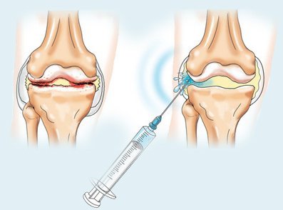 Коли потрібно колоти гіалуронову кислоту в суглоб?
