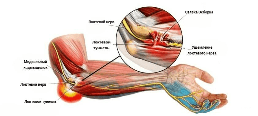 Компресія нерва в ліктьовому каналі: як виявити і лікувати? Компресія нерва в ліктьовому каналі: як виявити і лікувати?