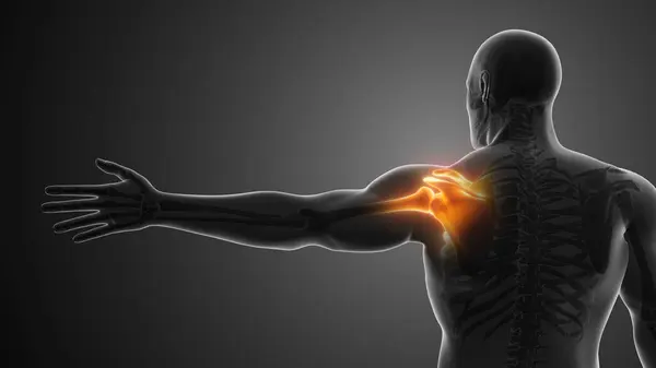 Пошкодження зв’язок плеча: як відновлюють рух і силу? Пошкодження зв’язок плеча: як відновлюють рух і силу?