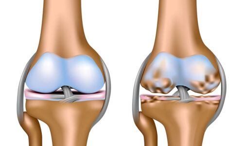 Що таке остеоартроз і як його лікують у Medicasano?