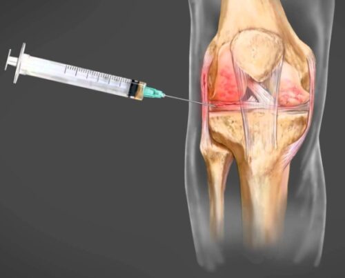 Як виглядає сучасна реабілітація після уколів у суглоб?