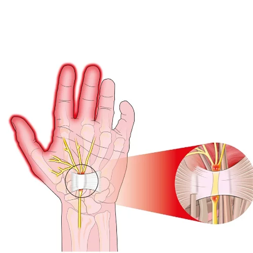Консервативне лікування тунельного синдрому: що справді працює?