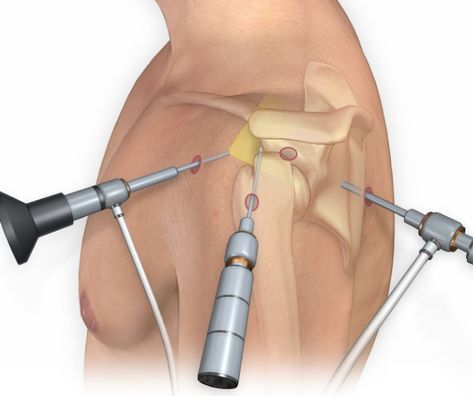 Артроскопия плеча: когда требуется вмешательство