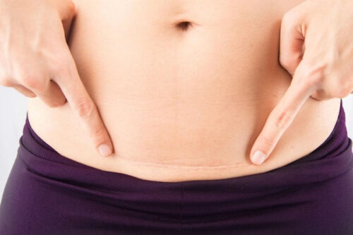      Боль в позвоночнике после кесарева сечения — причины и решения