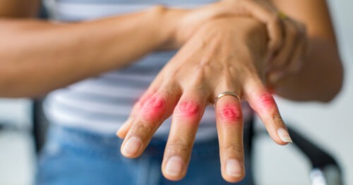 Пальцы стали менее гибкими — сигнал о начале ревматоидного процесса?