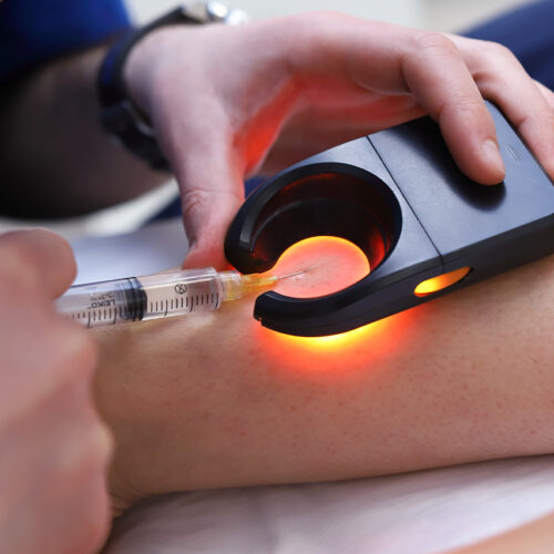 Як використовують венозний сканер під час склеротерапії?