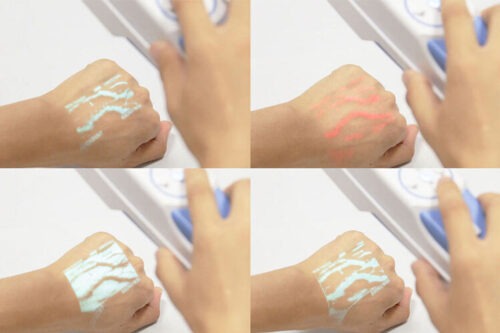 Як нові технології дозволяють лікувати варикоз менш травматично?