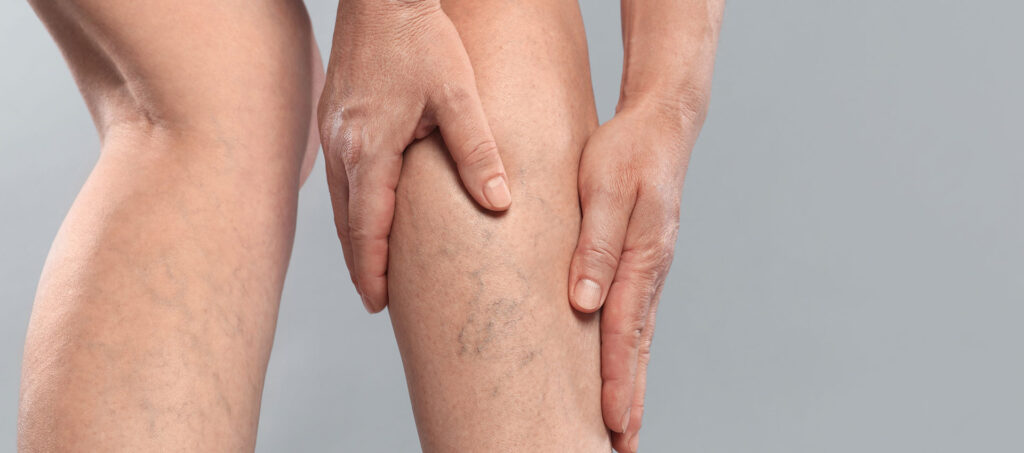 Як нові технології дозволяють лікувати варикоз менш травматично?