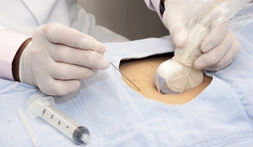 Інʼєкції під контролем УЗД: точність, безпека, ефективність