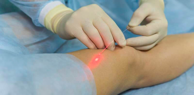 Ендовенозна лазерна коагуляція під УЗД — як це працює?