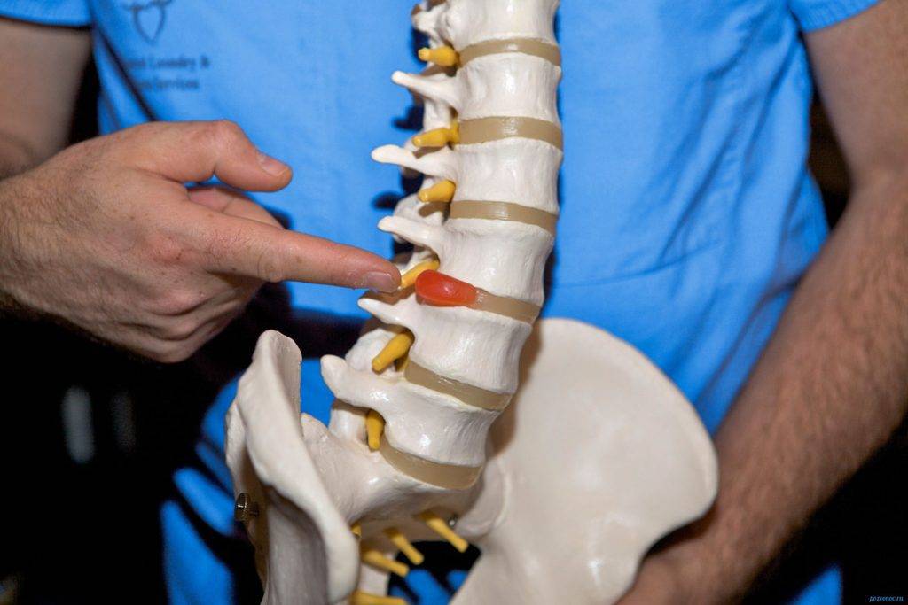Протрузія диска: з чого починати реабілітацію?