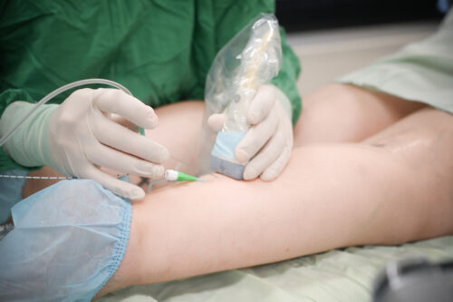 Ендовенозна лазерна коагуляція під УЗД — як це працює?