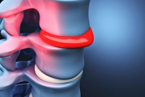 Протрузія диска: з чого починати реабілітацію?