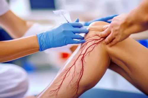 Як веносканер підвищує точність склеротерапії?