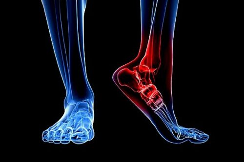 Що буде, якщо не лікувати частковий розрив зв’язки?