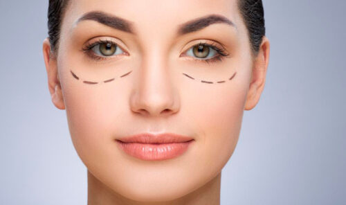 Блефаропластика верхніх повік: як відбувається операція?