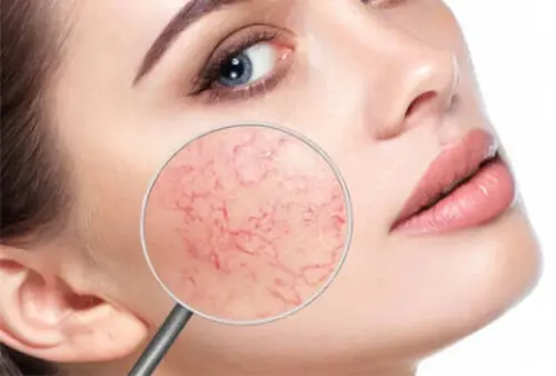 Кріолазерна терапія куперозу: що це таке?