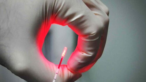 Ендовенозна лазерна коагуляція вен: як працює цей метод лікування варикозу?