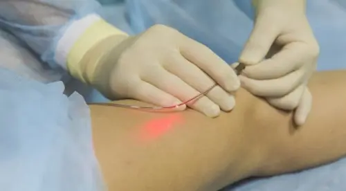 Кріолазерна склеротерапію CLaCS: як проходить процедура і кому вона підходить?