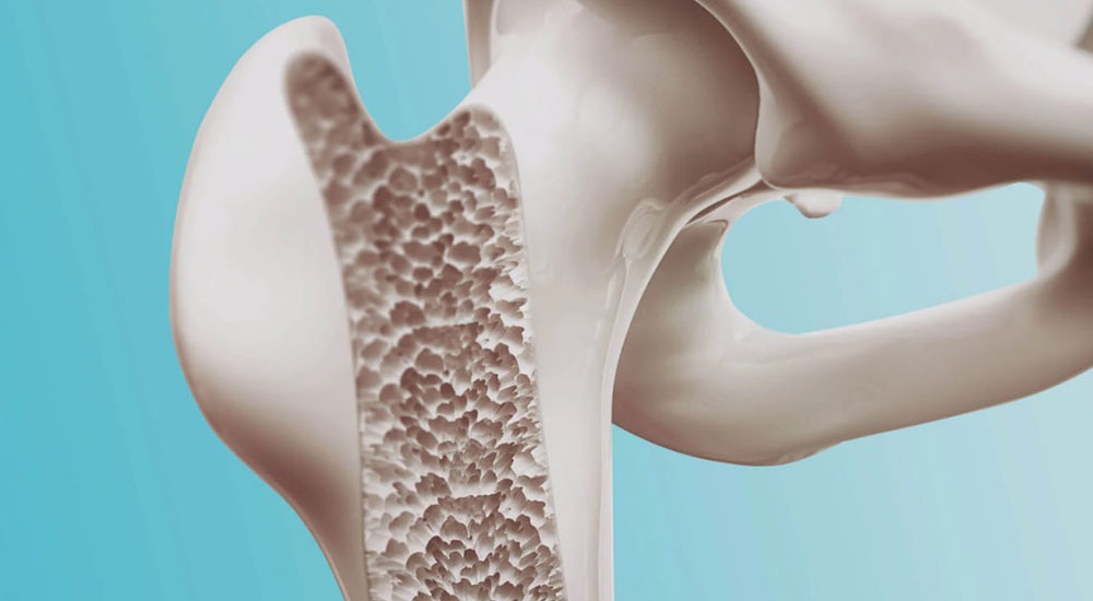 Діагностика остеопорозу: які обстеження допомагають визначити стан кісток?