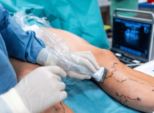 Коли потрібно звернутися до судинного хірурга: які симптоми проблем із судинами не можна ігнорувати?