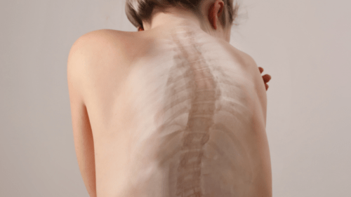 Можно ли исправить сколиоз без операции?