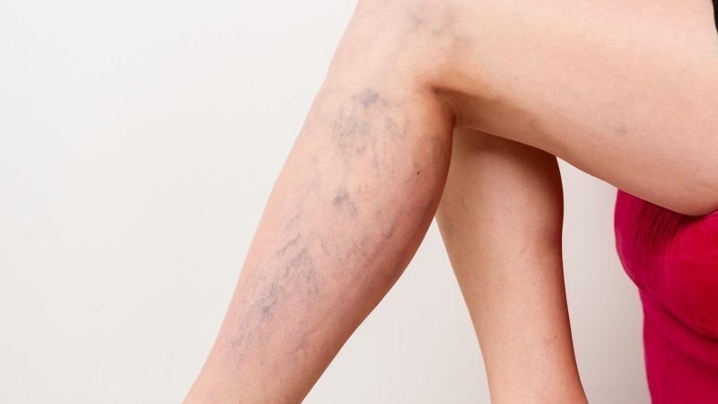 Ендовенозна лазерна коагуляція вен: як працює цей метод лікування варикозу?